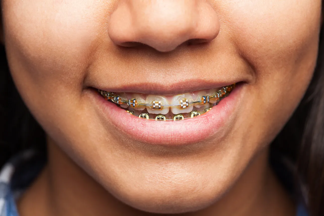 Champagne Braces